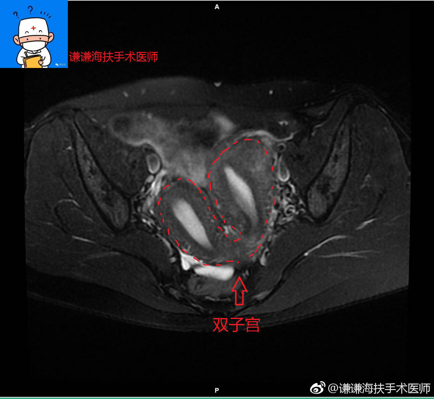 半套到底是什么意思?